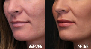 Juvederm Patient