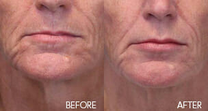 Restylane Patient