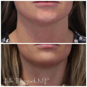 Kybella-04a-before-post