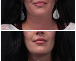 Kybella-05a-before-post