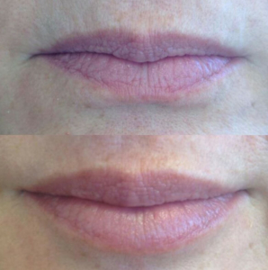 Juvederm