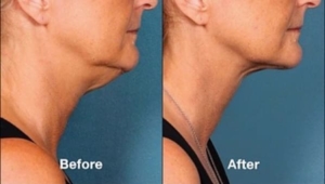 Kybella