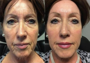 Liquid Facelift